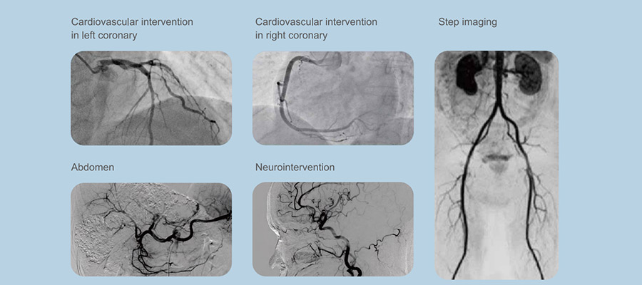 Vicor-CV Robin C/F Digital Subtraction Angiography System